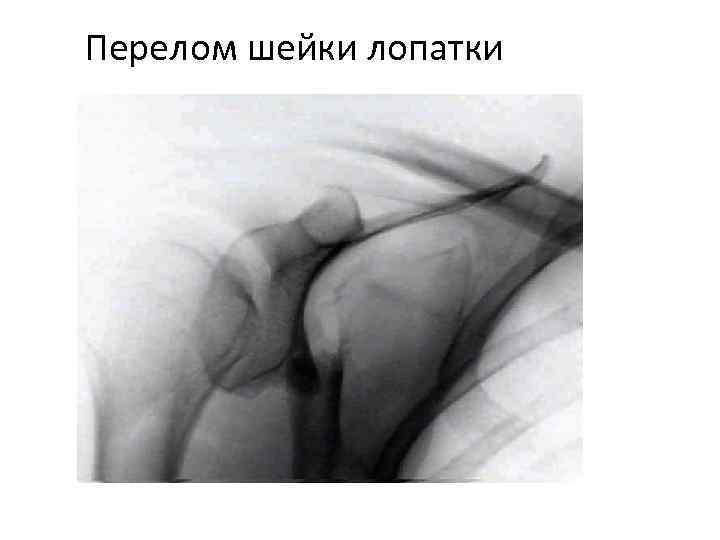Перелом шейки лопатки 