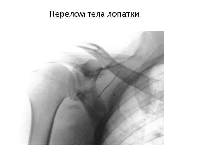 Перелом тела лопатки 