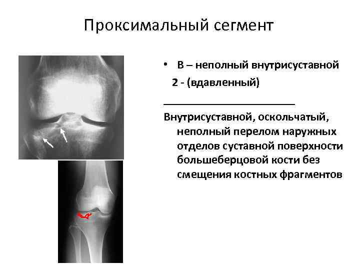 Рентгенограмма перелом костей голени thumbnail