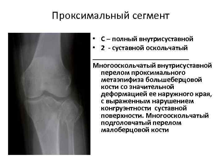 Перелом большеберцовой кости рентгеновские снимки thumbnail