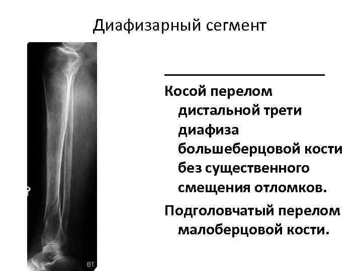 Диафизарный сегмент __________ Косой перелом дистальной трети диафиза большеберцовой кости без существенного смещения отломков.