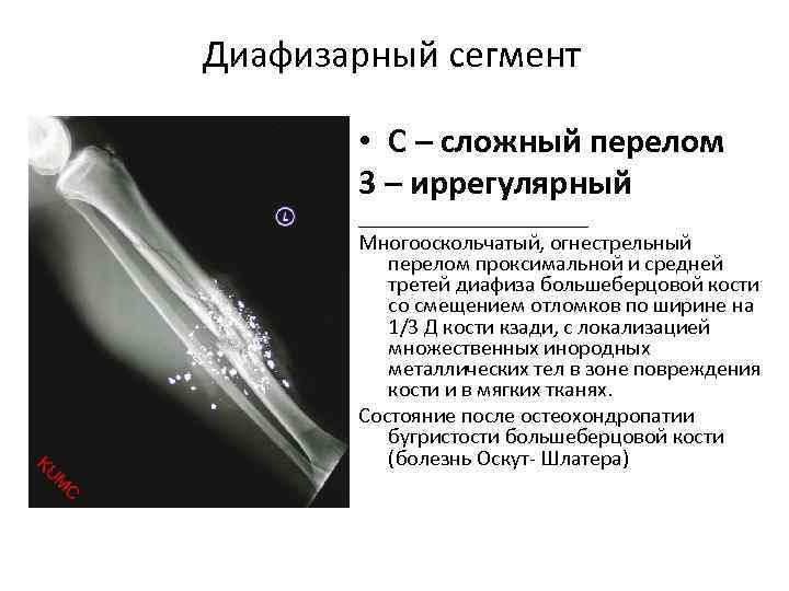 Рентген при переломе костей голени thumbnail