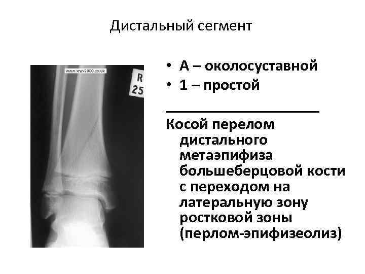 Описание рентгенограммы перелома большеберцовой кости thumbnail