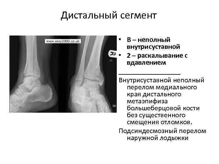 Перелом обеих костей голени рентген thumbnail