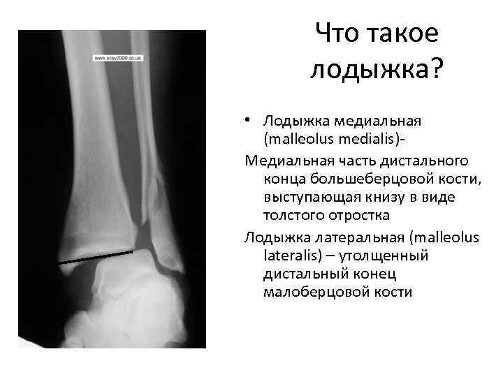 Рентгеновский снимок перелома голени thumbnail