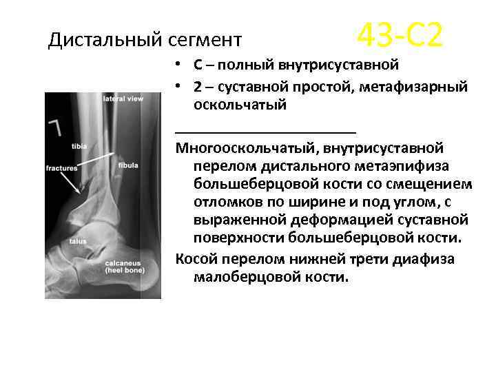 Дистальный сегмент 43 -С 2 • С – полный внутрисуставной • 2 – суставной