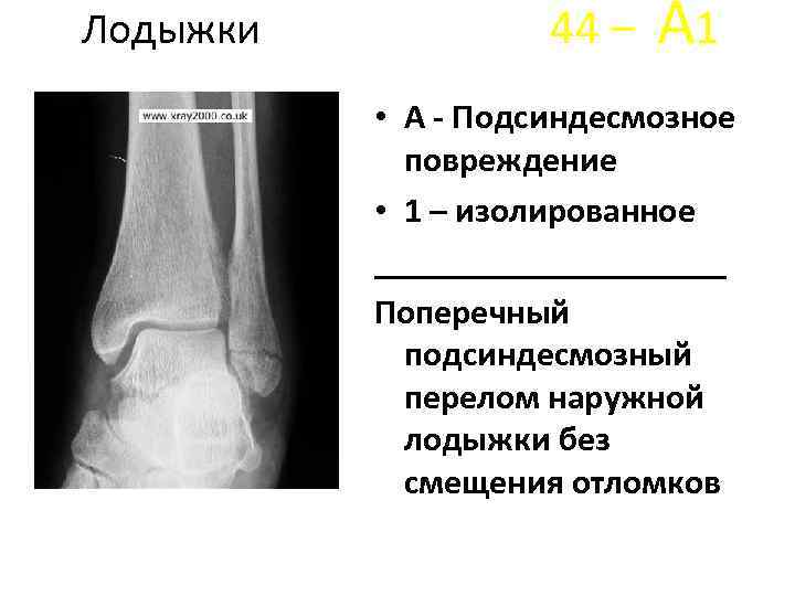 Рентген заключение перелома большеберцовой кости thumbnail