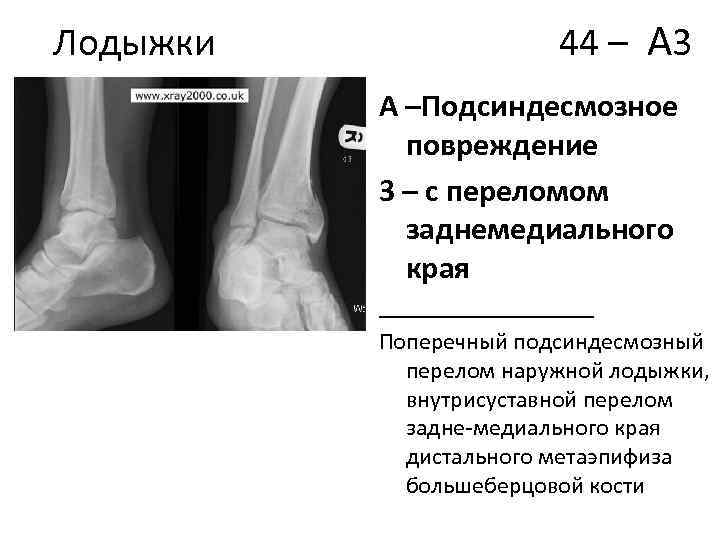Лодыжки 44 – А 3 А –Подсиндесмозное повреждение 3 – с переломом заднемедиального края