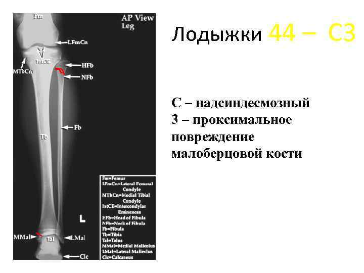 Лодыжки 44 – С – надсиндесмозный 3 – проксимальное повреждение малоберцовой кости С 3