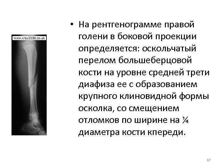  • На рентгенограмме правой голени в боковой проекции определяется: оскольчатый перелом большеберцовой кости