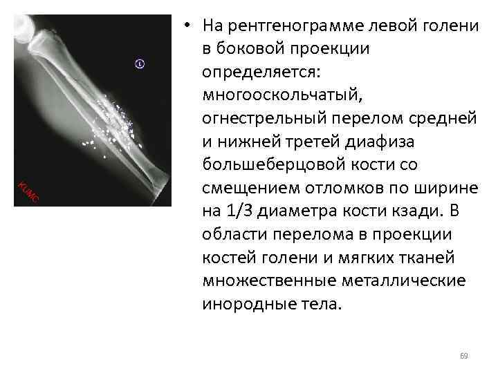  • На рентгенограмме левой голени в боковой проекции определяется: многооскольчатый, огнестрельный перелом средней