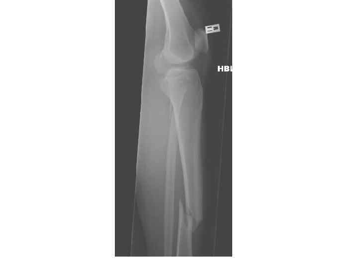 Рентген голени после перелома