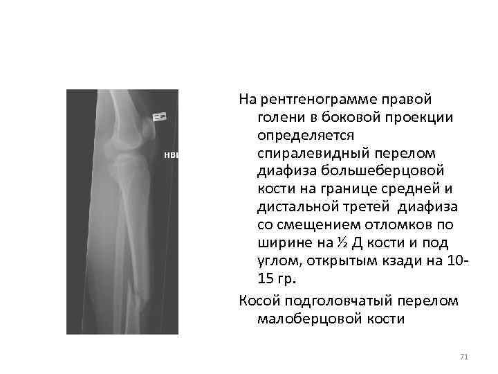 На рентгенограмме правой голени в боковой проекции определяется спиралевидный перелом диафиза большеберцовой кости на