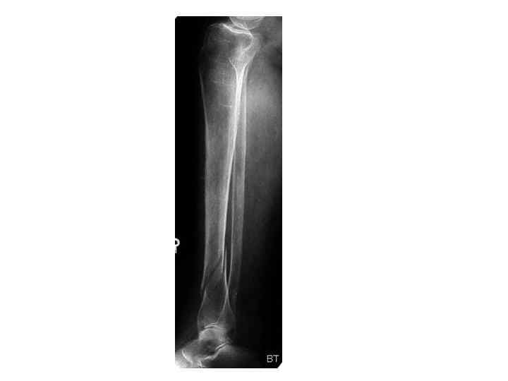 Рентгенограмма перелома костей голени
