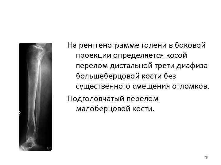 На рентгенограмме голени в боковой проекции определяется косой перелом дистальной трети диафиза большеберцовой кости