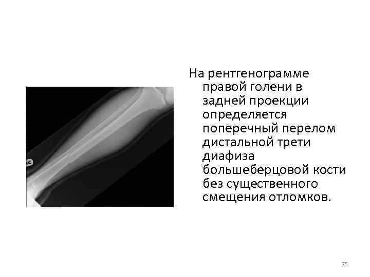 На рентгенограмме правой голени в задней проекции определяется поперечный перелом дистальной трети диафиза большеберцовой