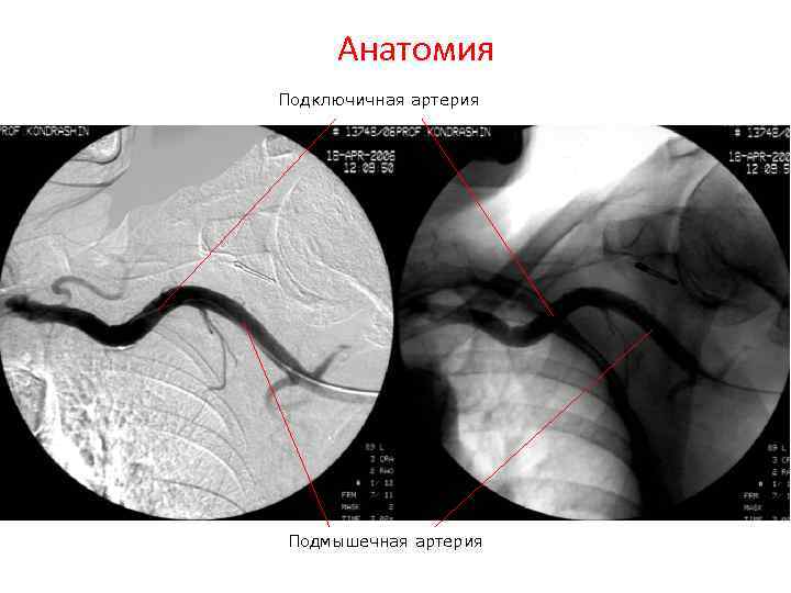 Анатомия Подключичная артерия Подмышечная артерия 