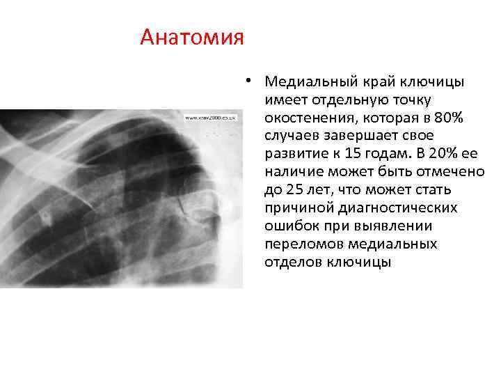 Описание рентгенограммы перелома ключицы thumbnail