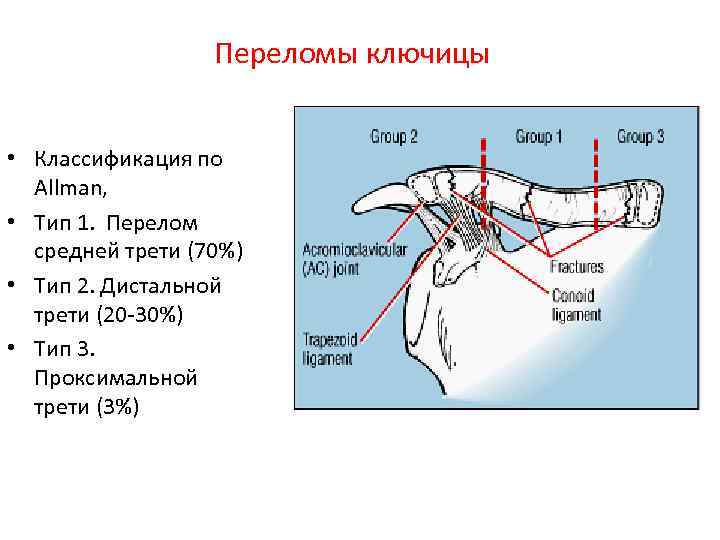 Переломы ключицы • Классификация по Allman, • Тип 1. Перелом средней трети (70%) •