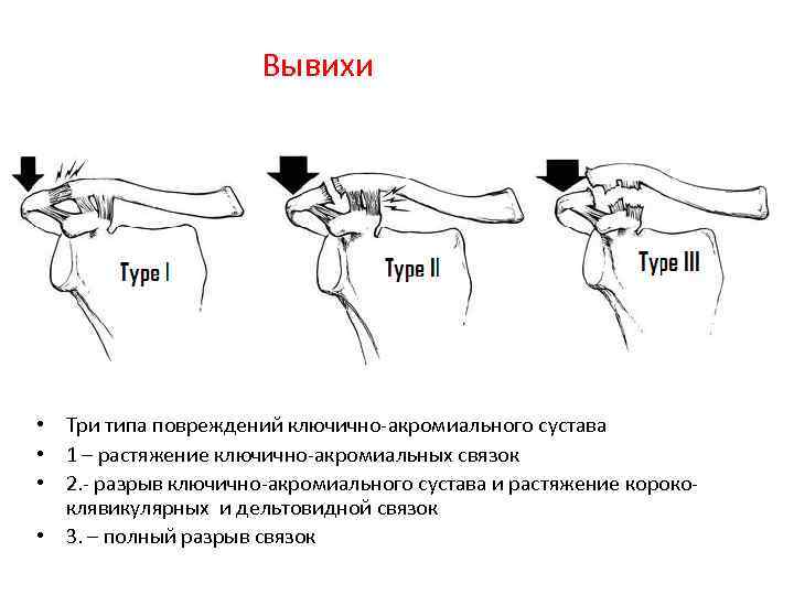 Вывихи • Три типа повреждений ключично-акромиального сустава • 1 – растяжение ключично-акромиальных связок •