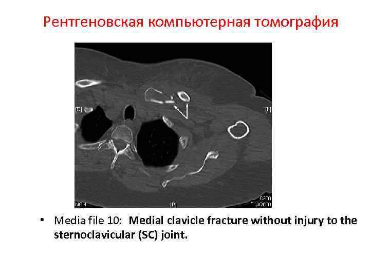 Рентгеновская компьютерная томография • Media file 10: Medial clavicle fracture without injury to the