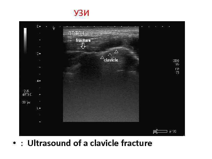 УЗИ • : Ultrasound of a clavicle fracture 