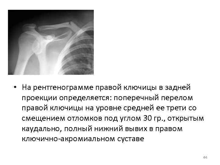  • На рентгенограмме правой ключицы в задней проекции определяется: поперечный перелом правой ключицы