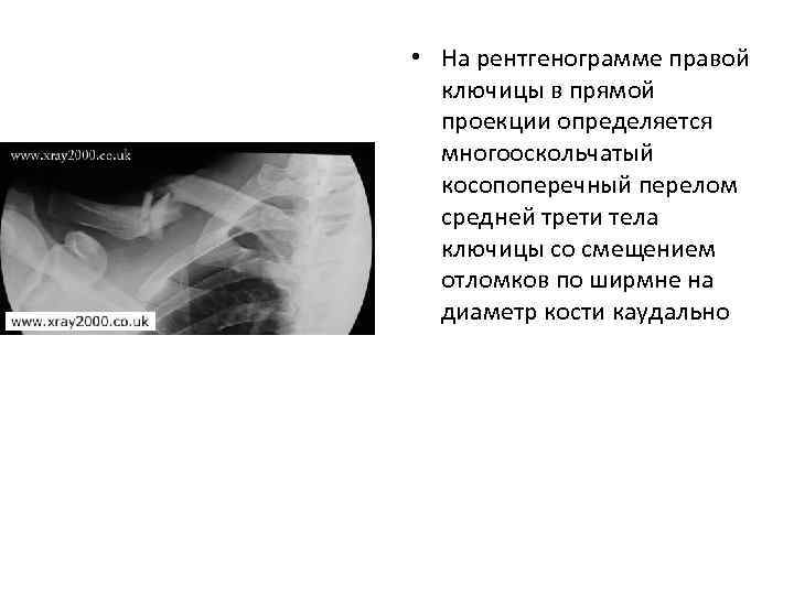  • На рентгенограмме правой ключицы в прямой проекции определяется многооскольчатый косопоперечный перелом средней