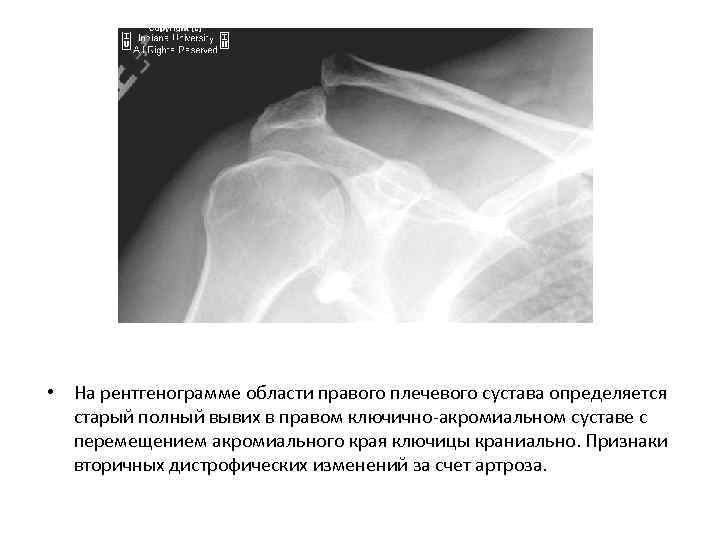  • На рентгенограмме области правого плечевого сустава определяется старый полный вывих в правом