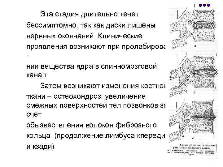 Эта стадия длительно течет бессимптомно, так как диски лишены нервных окончаний. Клинические проявления возникают