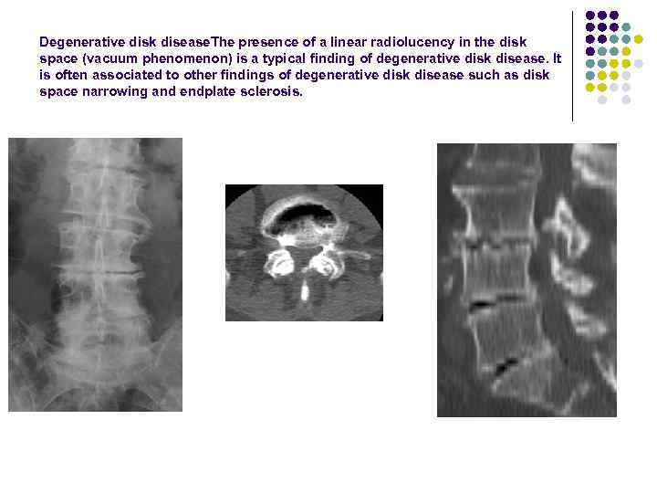 Degenerative disk disease. The presence of a linear radiolucency in the disk space (vacuum