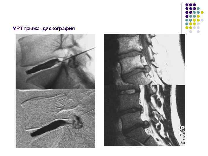 МРТ грыжа- дискография 