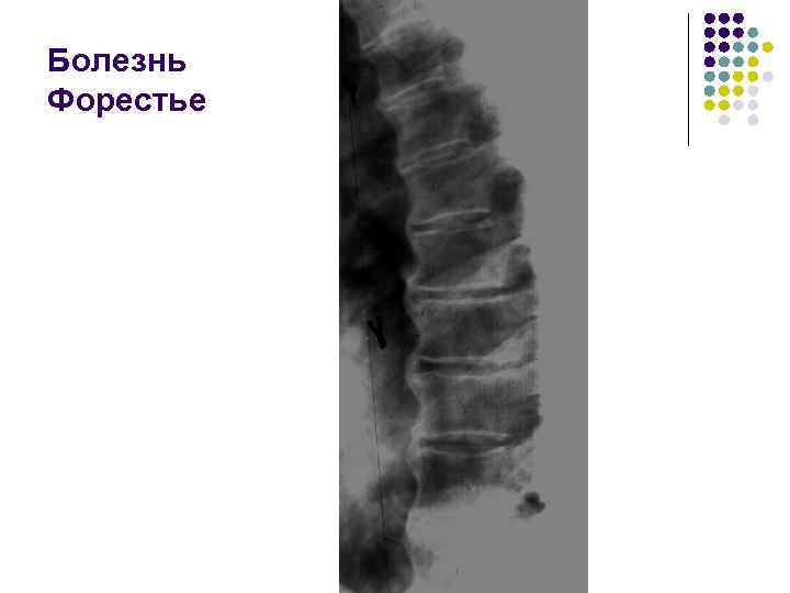 Болезнь Форестье 