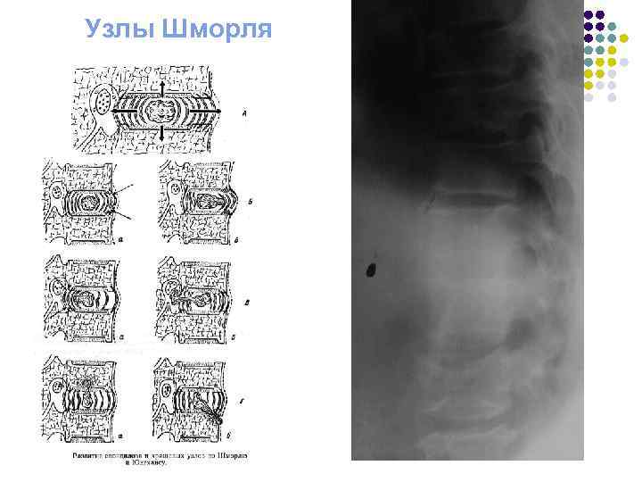 Дорсопатия на фоне дегенеративно дистрофических изменений позвоночника