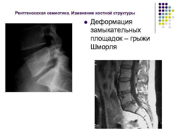 Рентгеновская семиотика. Изменение костной структуры l Деформация замыкательных площадок – грыжи Шморля 