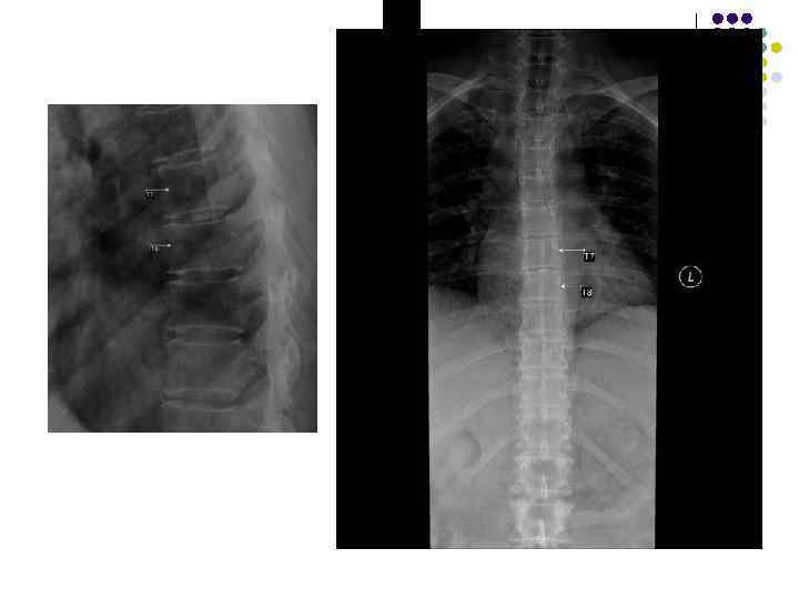 Обызвествление дисков 