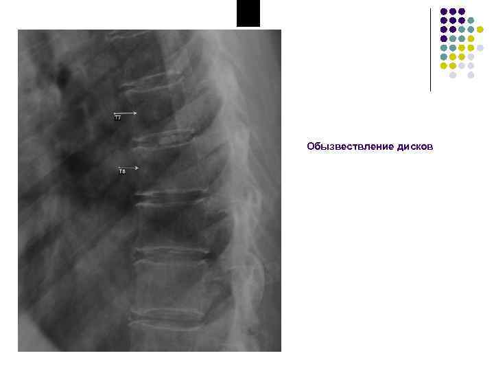 Обызвествление дисков 