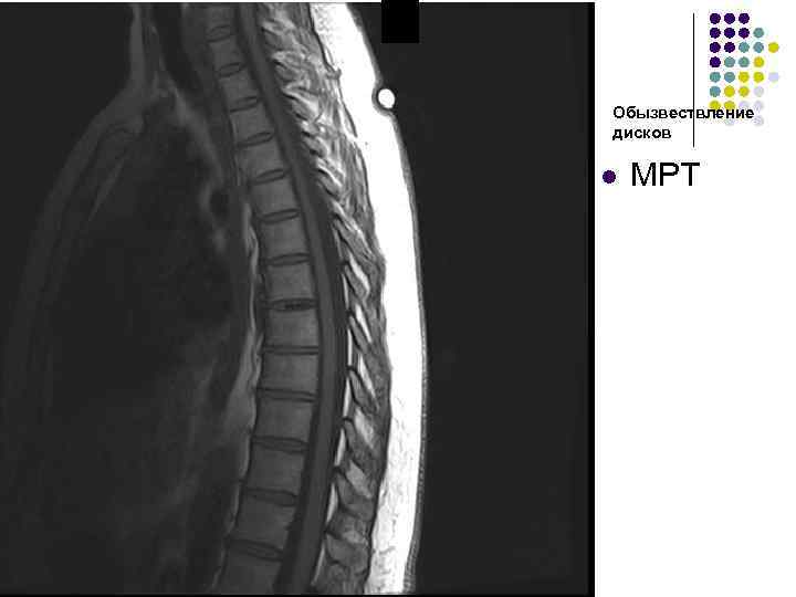 Обызвествление дисков l МРТ 