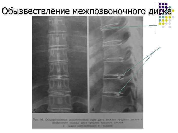 Обызвествление межпозвоночного диска 