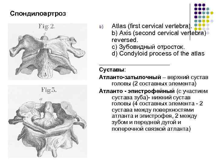 Спондилоартроз Atlas (first cervical vertebra). b) Axis (second cervical vertebra) reversed. c) Зубовидный отросток.
