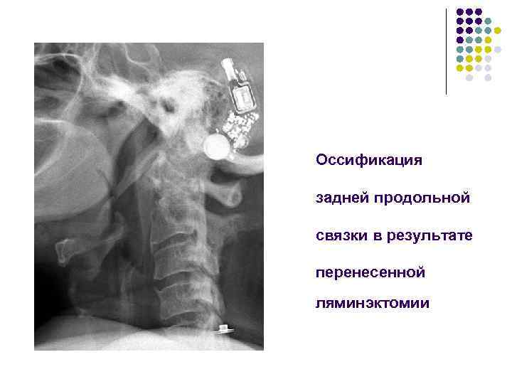 Оссификация задней продольной связки в результате перенесенной ляминэктомии 