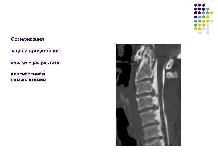 Оссификация задней продольной связки в результате перенесенной ляминэктомии 