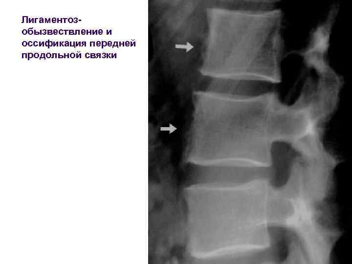 Лигаментозобызвествление и оссификация передней продольной связки 