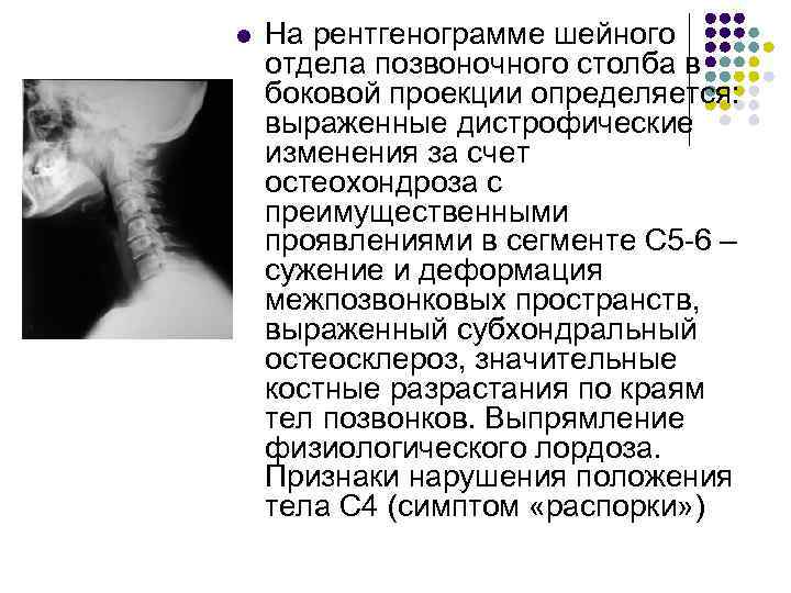 Стеноз отдела позвоночника. Протокол рентгена шейного отдела. Стеноз шейного отдела позвоночника. Рентгенограмма позвоночного столба боковая проекция. Стеноз шейного отдела симптомы.