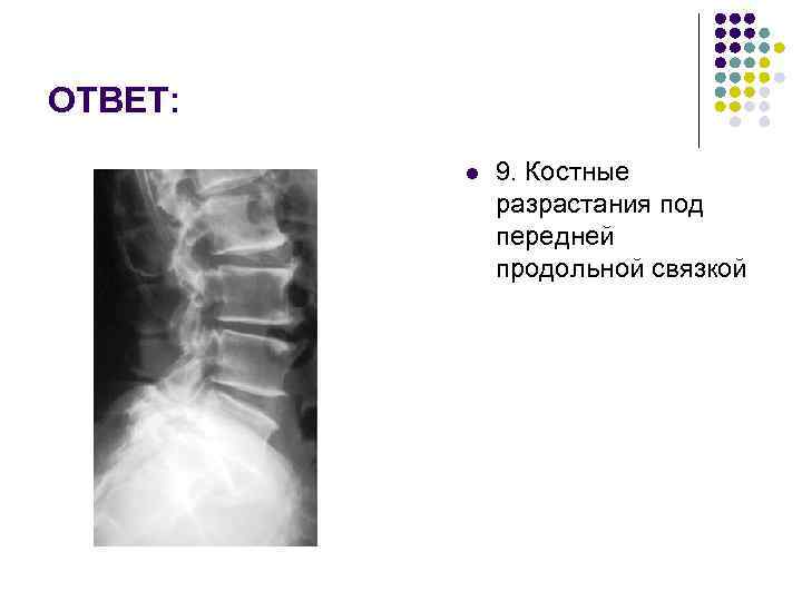 ОТВЕТ: l 9. Костные разрастания под передней продольной связкой 