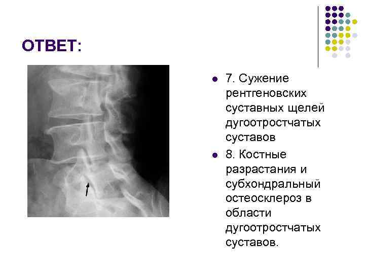ОТВЕТ: l l 7. Сужение рентгеновских суставных щелей дугоотростчатых суставов 8. Костные разрастания и