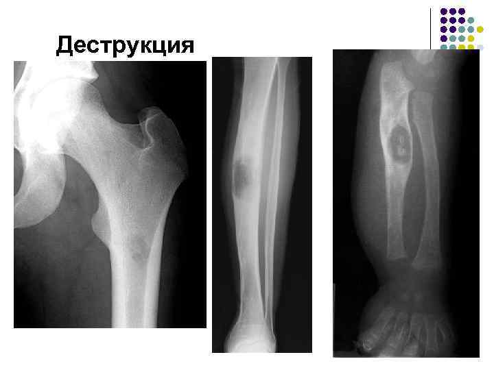 Огнестрельный остеомиелит. Очаг деструкции костной ткани рентген. Остеомиелит локтевого сустава рентген. Дистрофическая деструкция кости. Деструкция кости остеомиелит.