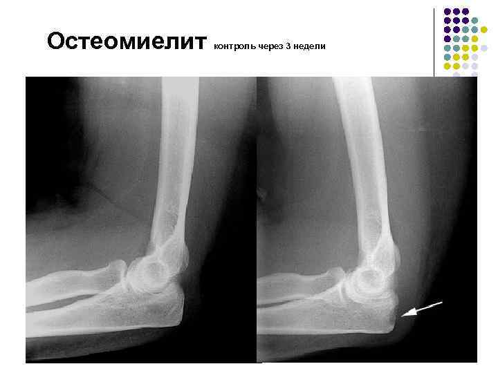 Острый остеомиелит диагностика