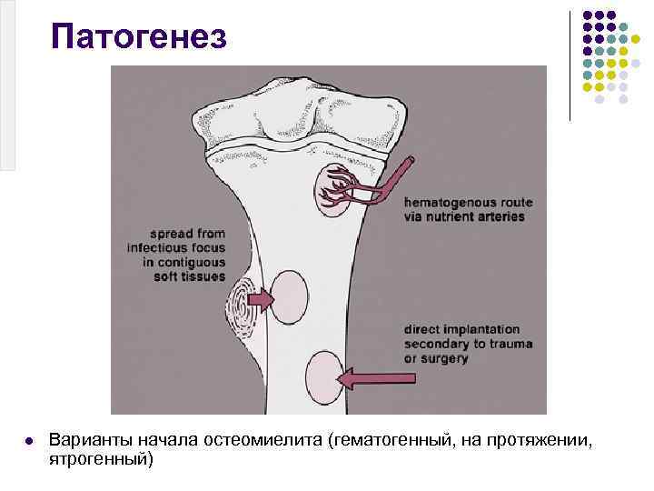 Патогенез l Варианты начала остеомиелита (гематогенный, на протяжении, ятрогенный) 