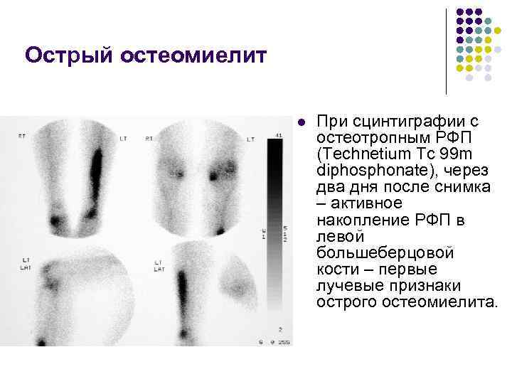 Острый остеомиелит l При сцинтиграфии с остеотропным РФП (Technetium Tc 99 m diphosphonate), через